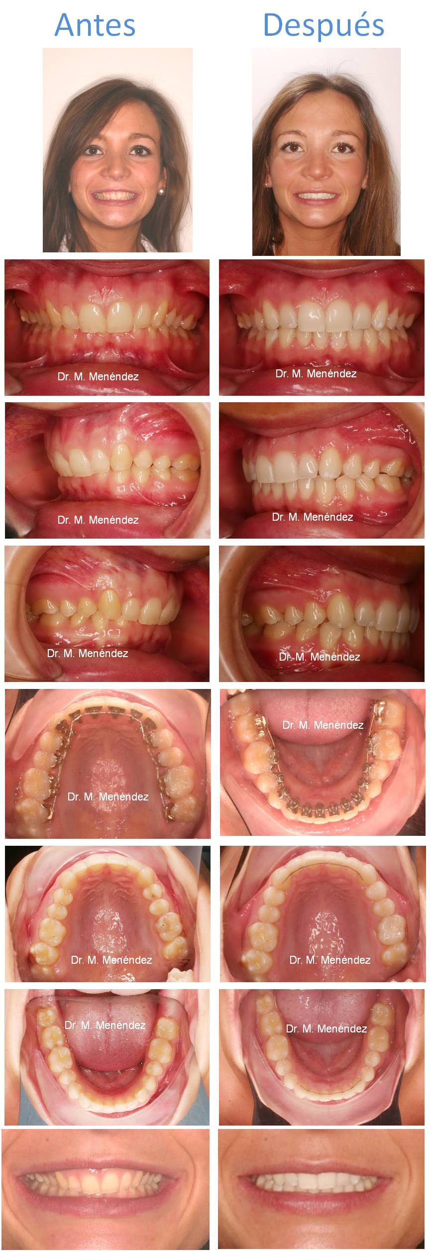 Caso resuelto ortodoncia lingual en Clínica Menéndez