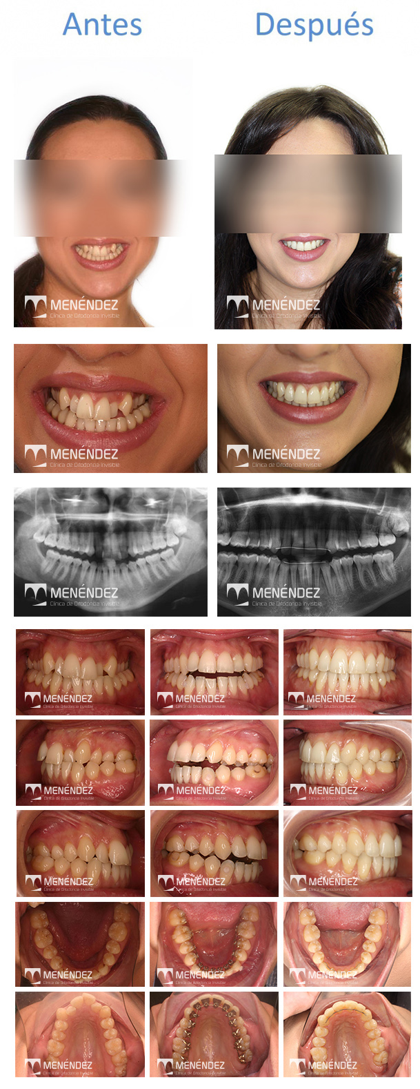 Ortodoncia granada sistema lingual Menendez