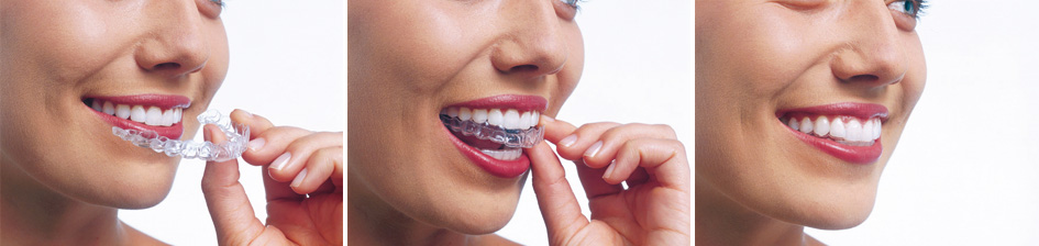 Invisalign Granada