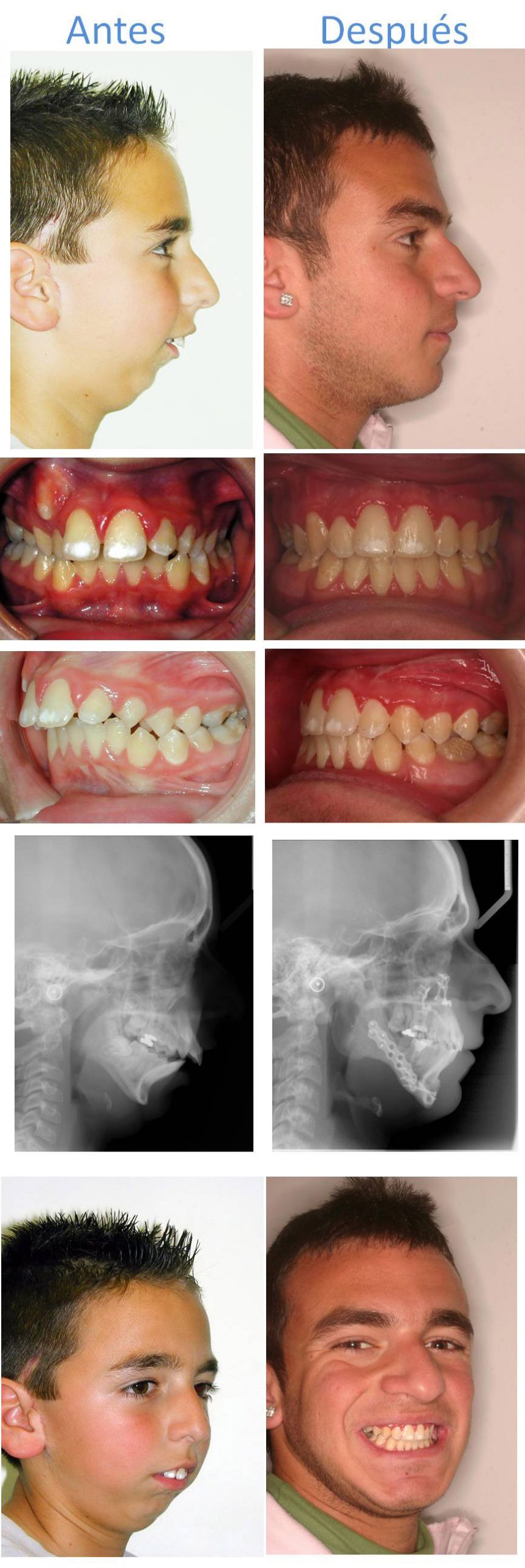 Caso resuelto de hipoplasia mandibular severa