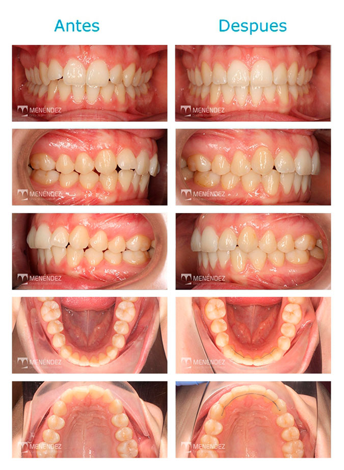 Granada Ortodoncia Invisalign en 19 meses