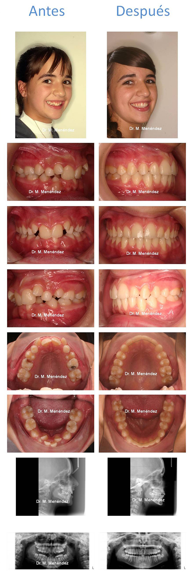 Sonrisa gingival