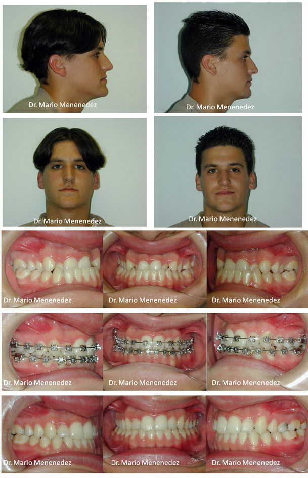 Caso resuelto de ortodoncia complejo