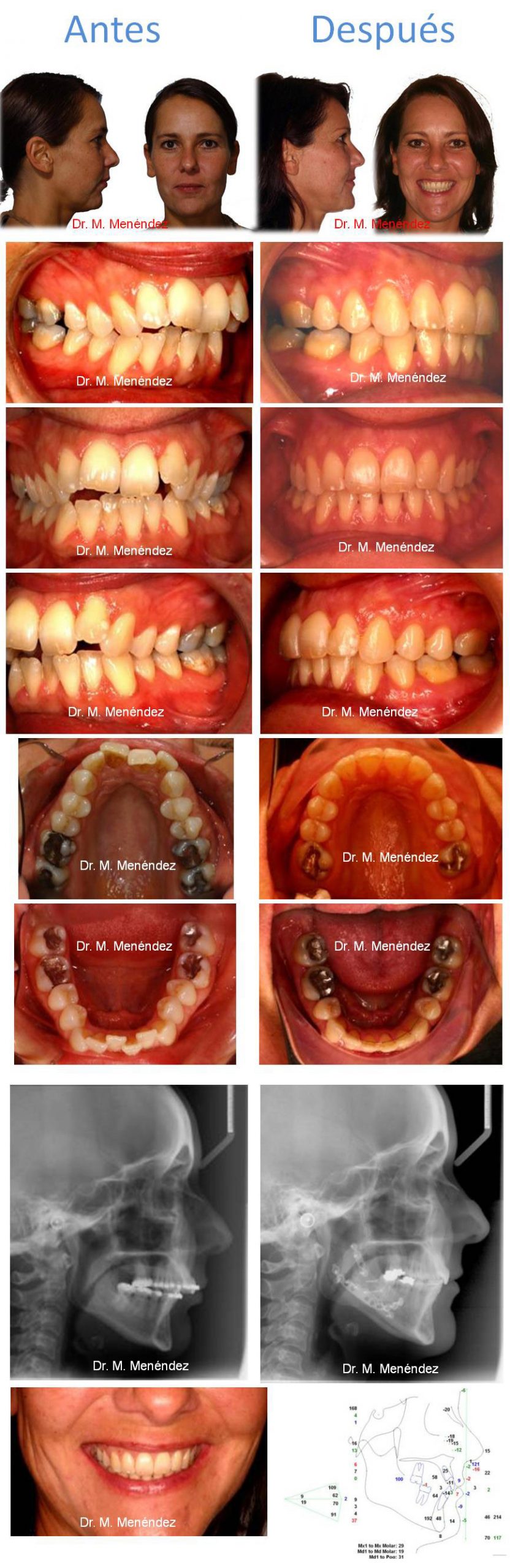 Caso resuelto en la Clínica Menédez, ortodoncia Granada