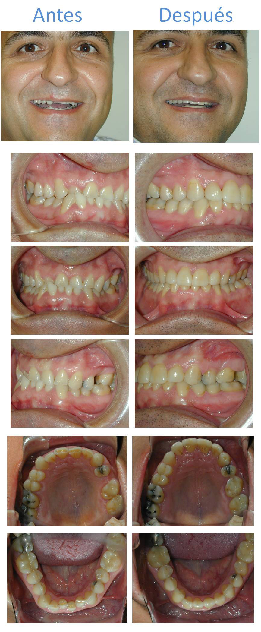 caso resuelto de desgaste dental