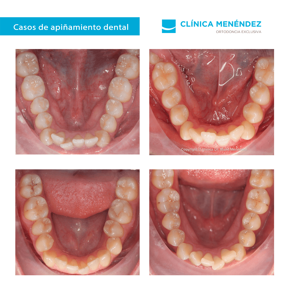 fotos apiñamiento dental fotos apiñamiento dental