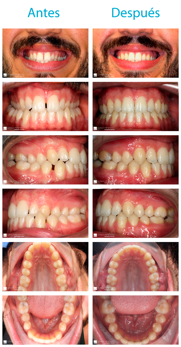 Caso resuelto de paciente con dientes separados