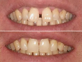 ortodoncia invisalign granada menendez