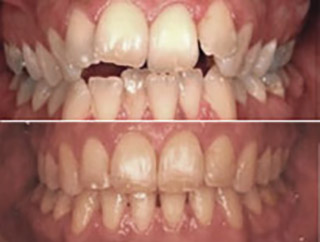 ortodoncia lingual granada menendez 03