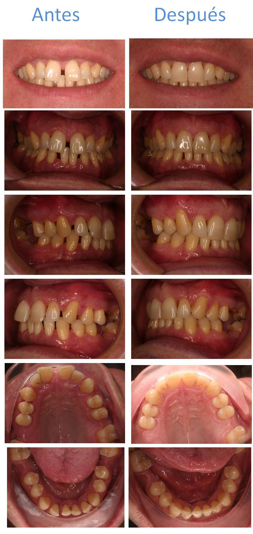 Caso resuelto de paciente con dientes separados