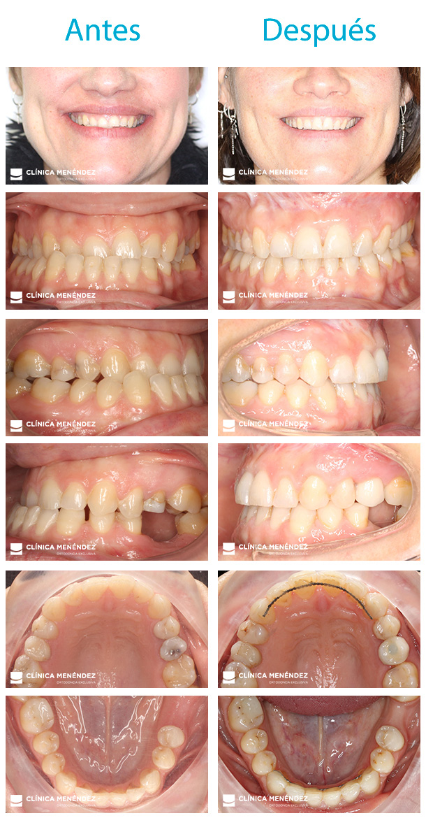 Caso resuelto de hipoplasia mandibular severa