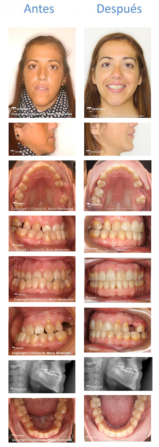 Hipoplasia maxilar superior caso resuelto