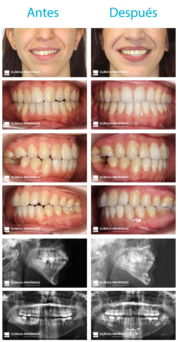 Caso resuelto de hipoplasia mandibular severa