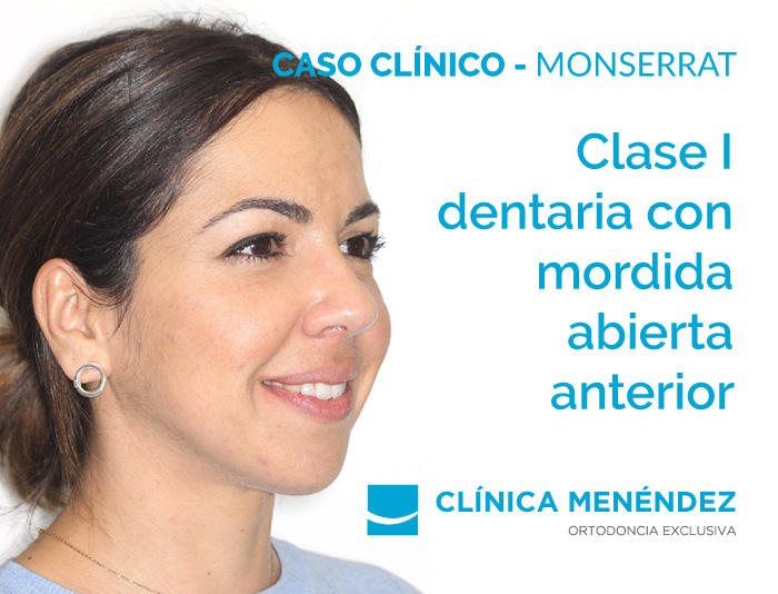 monserrat ortodoncia invisalign 2021