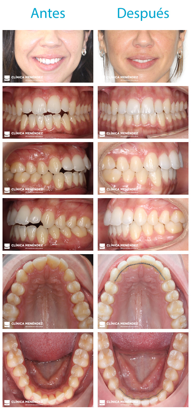 monserrat ortodoncia invisalign caso 2021 Caso Invisalign en Granada Menendez