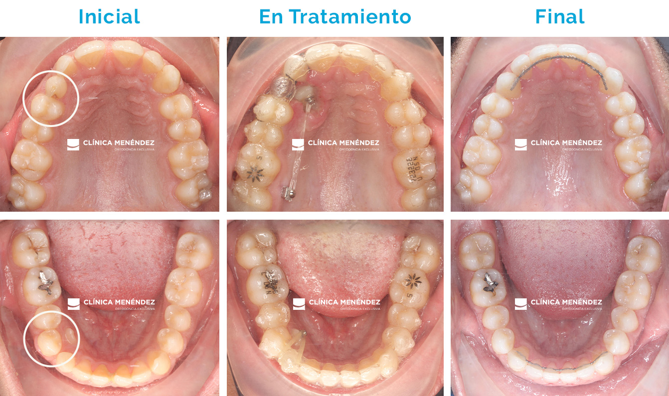 Clase I esquelética y dentaria