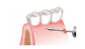 aparatos microtornillos