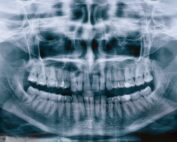 cirugia ortognática