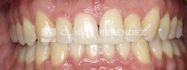 1 CLASE II CON SOBREMORDIDA SEVERA Y MORDIDA EN TIJERA TRATADO CON INVISALIGN Fin