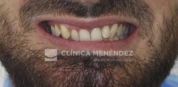 1 CLASE II CON SOBREMORDIDA SEVERA Y MORDIDA EN TIJERA TRATADO CON INVISALIGN INICIO (2)