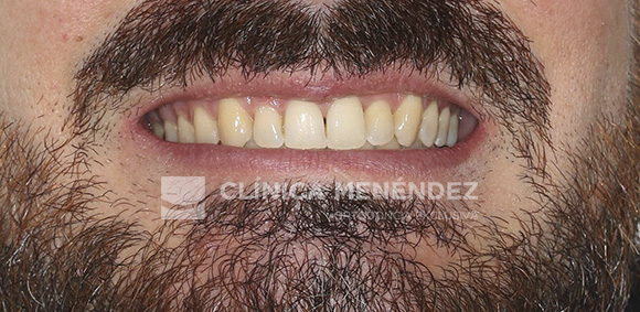 1 CLASE II CON SOBREMORDIDA SEVERA Y MORDIDA EN TIJERA TRATADO CON INVISALIGN INICIO FIN (1)
