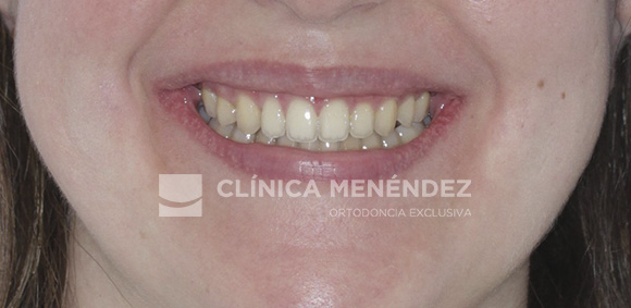 10 CLASE II MORDIDA ABIERTA SEVERA HABITO LINGUAL TRATADO CON INVISALIGN FIN