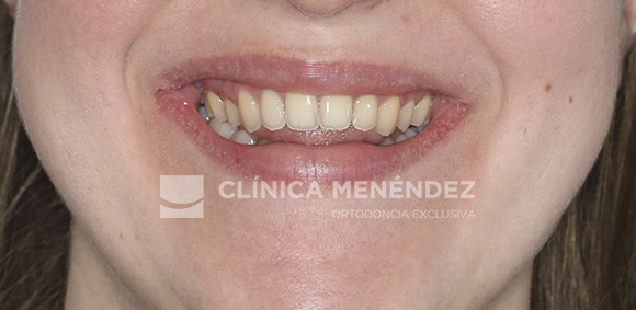10 CLASE II MORDIDA ABIERTA SEVERA HABITO LINGUAL TRATADO CON INVISALIGN INICIO