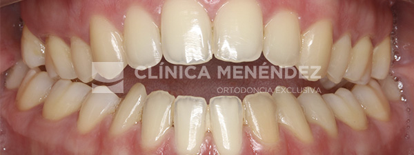 10 CLASE II MORDIDA ABIERTA SEVERA HABITO LINGUAL TRATADO CON INVISALIGN Inicio (1)