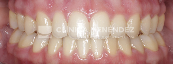 10 CLASE II MORDIDA ABIERTA SEVERA HABITO LINGUAL TRATADO CON INVISALIGN Inicio copia