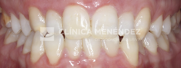 11 CLASE II DERECHO Y CLASE I IZQUIERDA ASIMETRIA DE LA LINEA MEDIA INFERIOR TRATADO CON INVISALIGN Fin