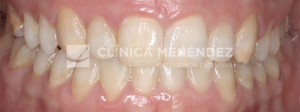 11 CLASE II DERECHO Y CLASE I IZQUIERDA ASIMETRIA DE LA LINEA MEDIA INFERIOR TRATADO CON INVISALIGN Inicio