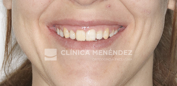 11 CLASE II DERECHO Y CLASE I IZQUIERDA ASIMETRIA DE LA LINEA MEDIA INFERIOR TRATADO CON INVISALIGN FIN