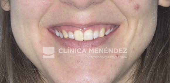11 CLASE II DERECHO Y CLASE I IZQUIERDA ASIMETRIA DE LA LINEA MEDIA INFERIOR TRATADO CON INVISALIGN INICIO