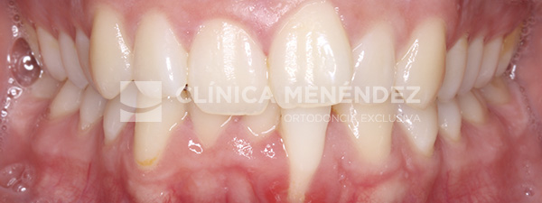 13 CLASE I CONINCISIVO INFERIOR PERIODONTAL SEVERA RECESION ENCIA TRATADO CON BRACKETS METÁLICOS INICIO