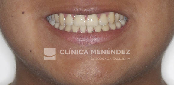 15 CLASE I APIÑAMIENTO TRATADO CON BRACKTS METÁLICOS FIN