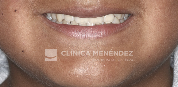15 CLASE I APIÑAMIENTO TRATADO CON BRACKTS METÁLICOS INICIO