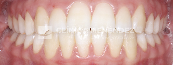 16 CLASE I MORDIDA CRUZADA ANTERIOR TRATADO CON BRACKETS DE ZAFIRO FIN