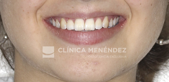 16 CLASE I MORDIDA CRUZADA ANTERIOR TRATADO CON BRACKETS DE ZAFIRO FIN