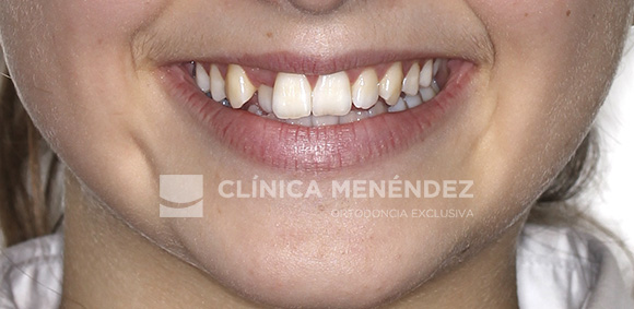 16 CLASE I MORDIDA CRUZADA ANTERIOR TRATADO CON BRACKETS DE ZAFIRO INICIO