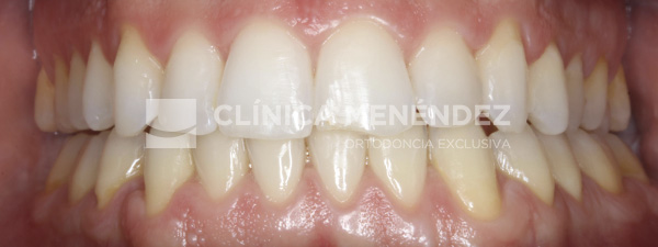 18 CLASE III ADULTO TRATADO CON INVISALIGN FIN
