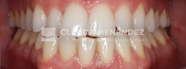 18 CLASE III ADULTO TRATADO CON INVISALIGN INICIO