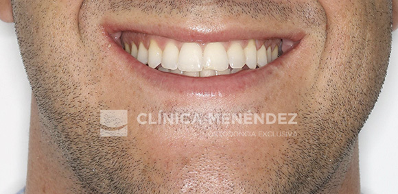 18 CLASE III ADULTO TRATADO CON INVISALIGN FIN