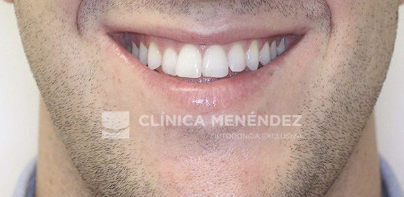 18 CLASE III ADULTO TRATADO CON INVISALIGN INICIO