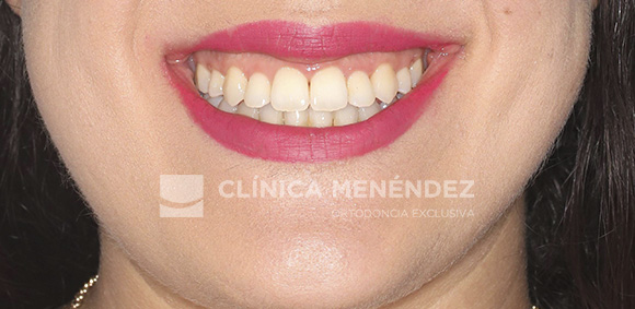 19 CLASE III CON MORDIDA ABIERTA ADULTO TRATADA CON CIRUGIA ORTOGNATICA FINV