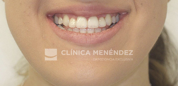 19 CLASE III CON MORDIDA ABIERTA ADULTO TRATADA CON CIRUGIA ORTOGNATICA INICO