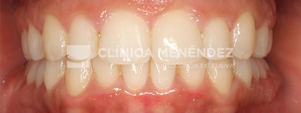 20 CLASE I CON APIÑAMIENTO TRATADA CON BRACKETS DE ZAFIRO FIN