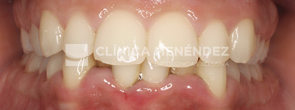 20 CLASE I CON APIÑAMIENTO TRATADA CON BRACKETS DE ZAFIRO INICIO