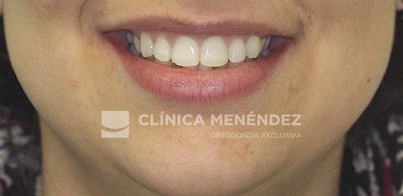 20 CLASE I CON APIÑAMIENTO TRATADA CON BRACKETS DE ZAFIRO FIN