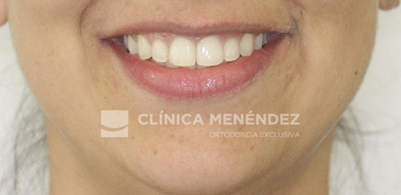 20 CLASE I CON APIÑAMIENTO TRATADA CON BRACKETS DE ZAFIRO INICIO