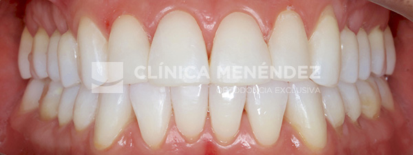 21 CLASE III CON MICRODONCIA DE INCISIVOS LATERALES SUPERIROES TRATADA CON INVISALIGN + ESTETICA DENTAL FIN
